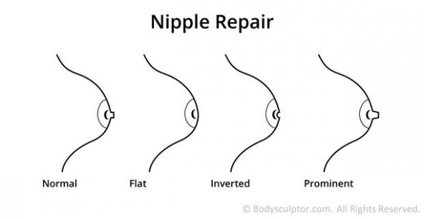 6_Diagram_Nipple_Repair-01